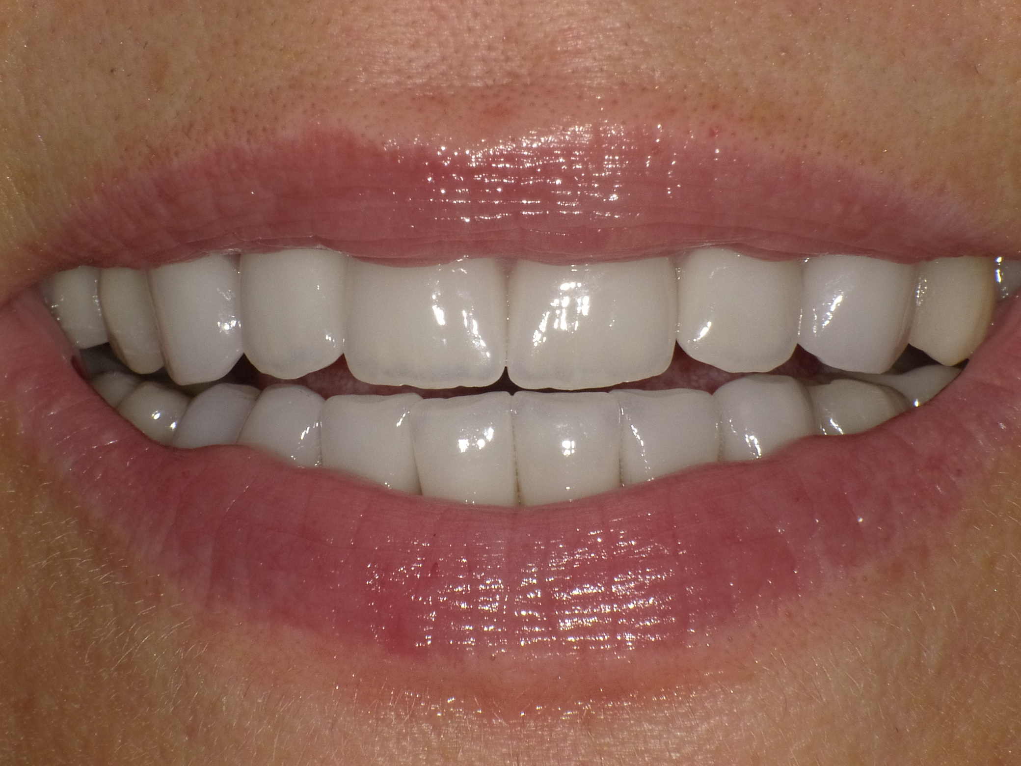 Optimierung mit vollkeramischen Kronen und Veneers im Smile-Design in nur 2 Terminen